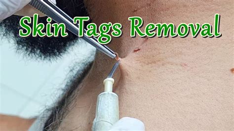 rf skin tag removal|skin tags removal procedure.